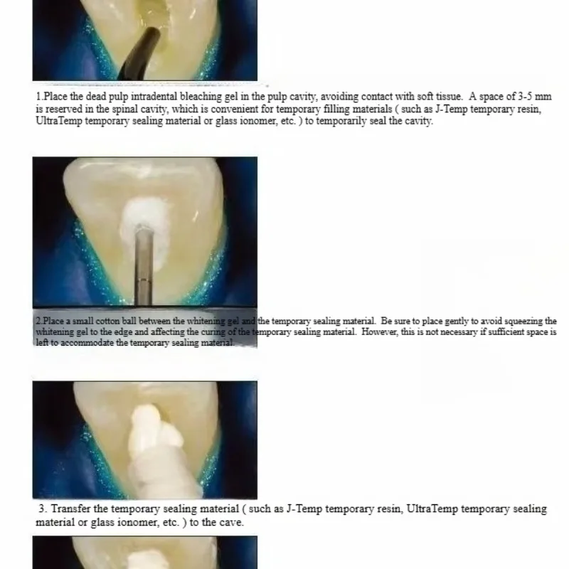Dental Oral Restoration Materi - Teeth Whitening Effects review and price