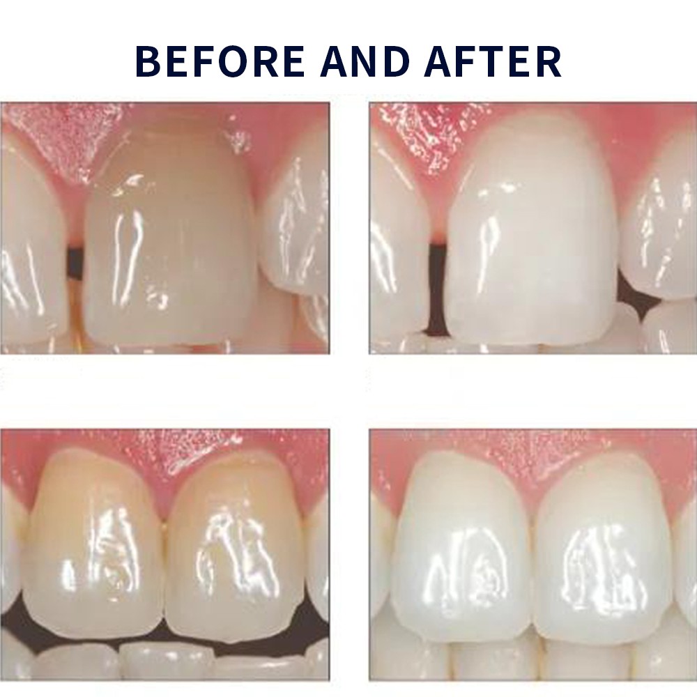 Opalescence Whitening 20% PF 2 - Teeth Whitening With Hydrogen Peroxide review and price