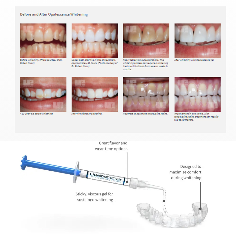 Opalescence Whitening 20% PF 2 - Teeth Whitening With Hydrogen Peroxide review and price
