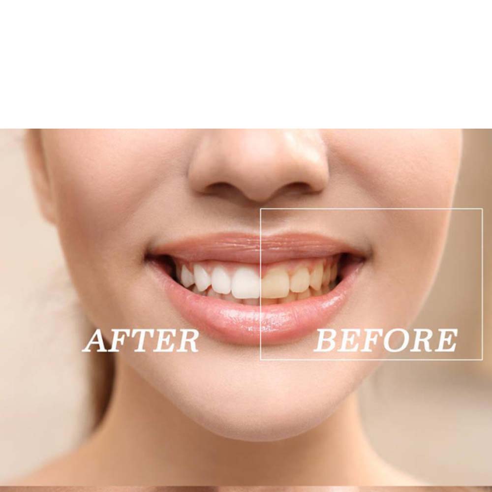 Top Quality Peroxide Teeth Whi - Teeth Whitening Led Kit review and price
