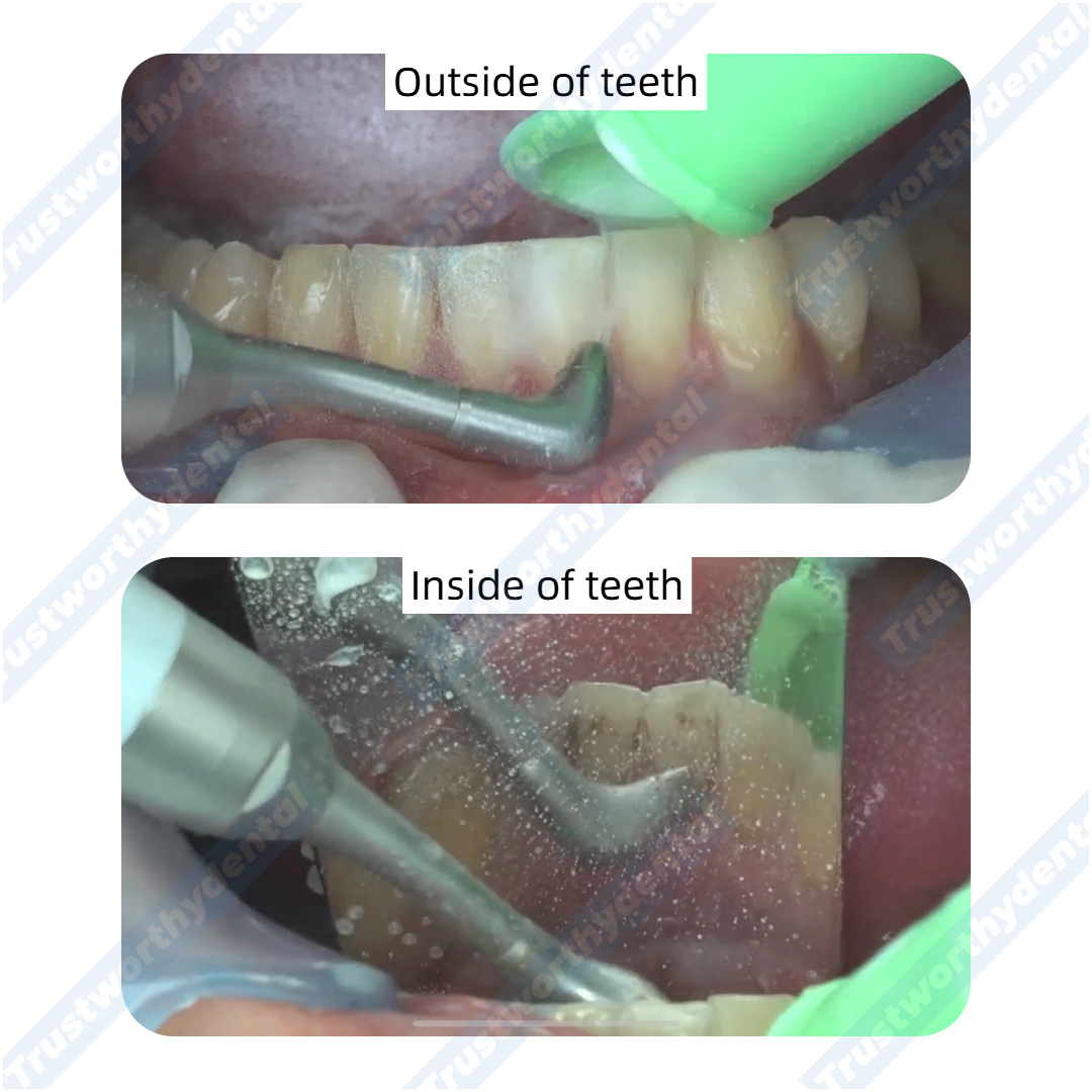 Dental Air Polisher Oral Autoc - Colgate Whitening Teeth review and price