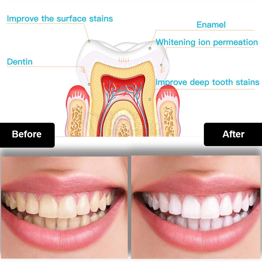 Dental Teeth Whitening Kit Min - Teeth Whitening Led Kit review and price